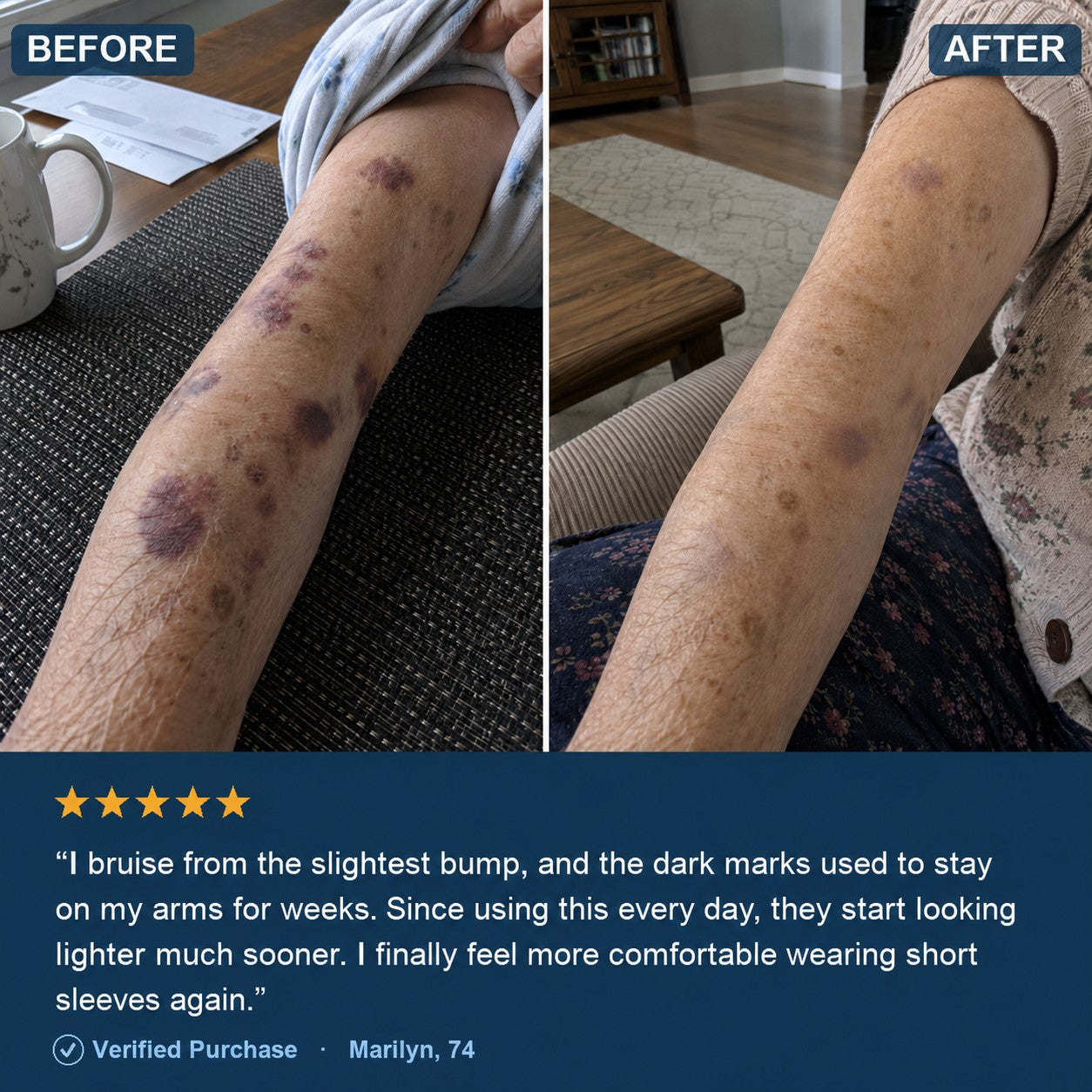 Before and after — forearm bruises fading with daily use