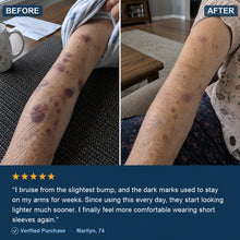 Before and after — forearm bruises fading with daily use