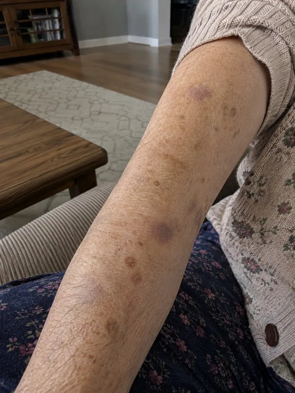 After — same forearm, 60 days, fewer marks