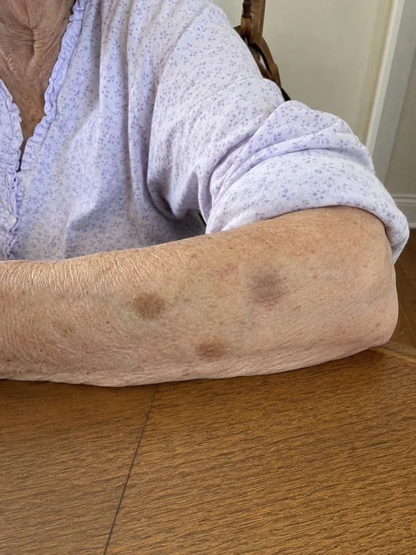 After — same forearm, day 60, fewer marks