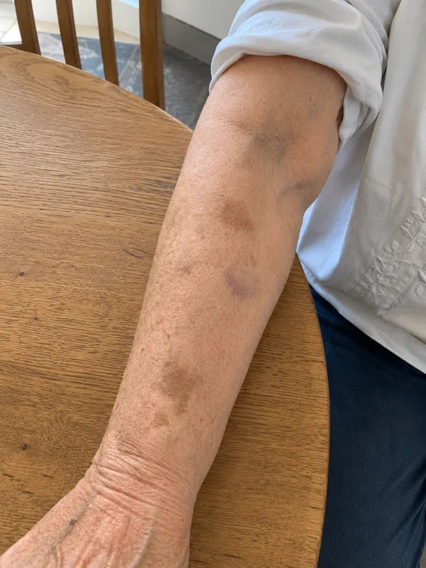 After — both forearms, sleeves pushed up, day 60