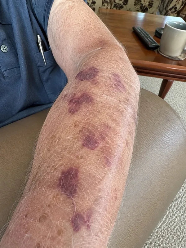 Before — forearm with several marks, day 1
