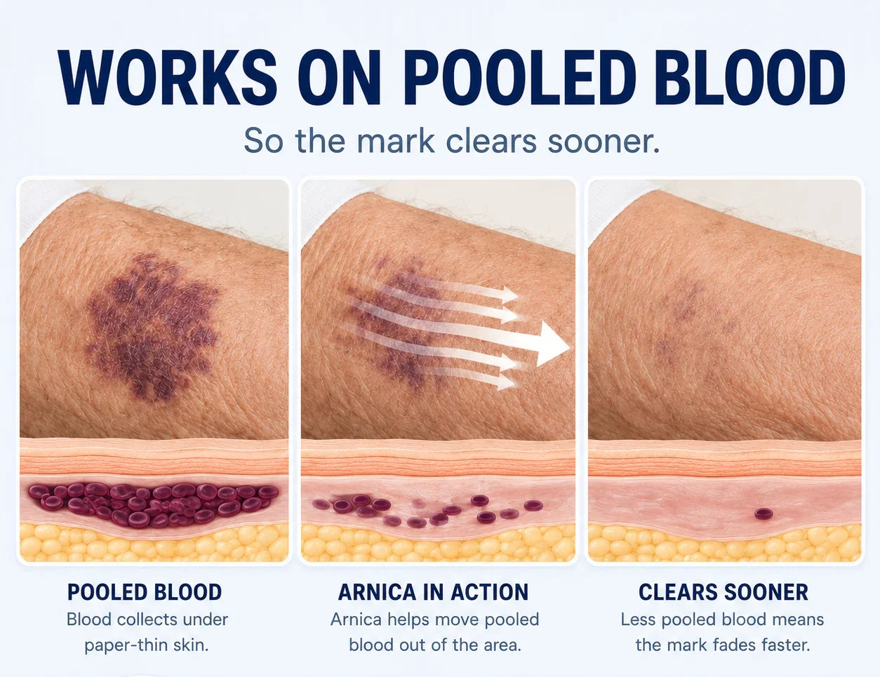 How arnica works: pooled blood under paper-thin skin is moved out, so the mark clears sooner