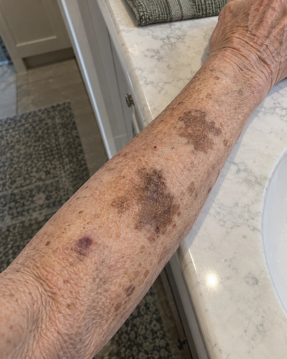 Lingering brown patches — Before