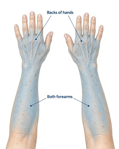 Application diagram highlighting both forearms and the backs of both hands