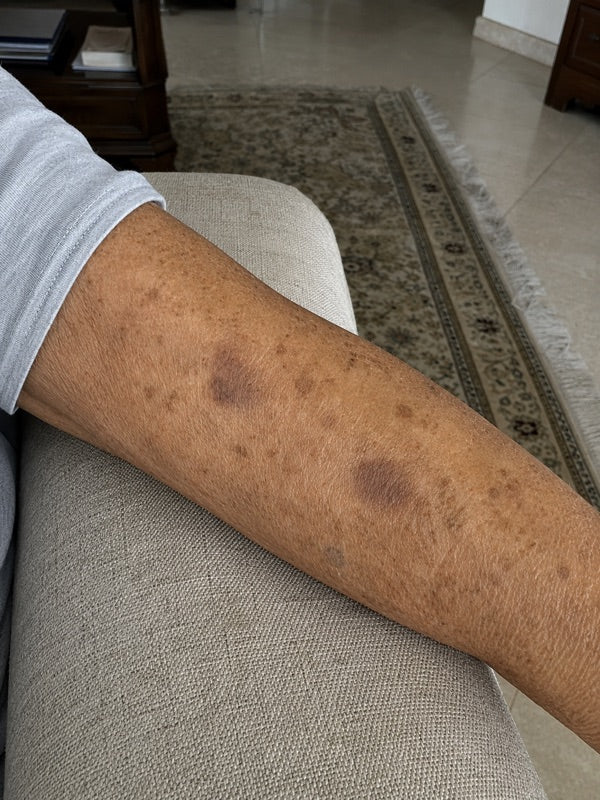 After — the same forearm, day 60, fewer bruises