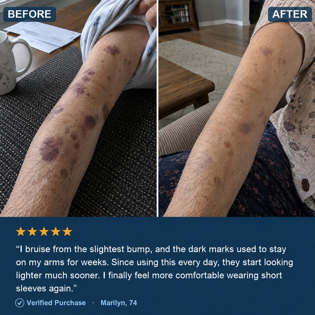 Before and after — forearm bruises fading with daily use