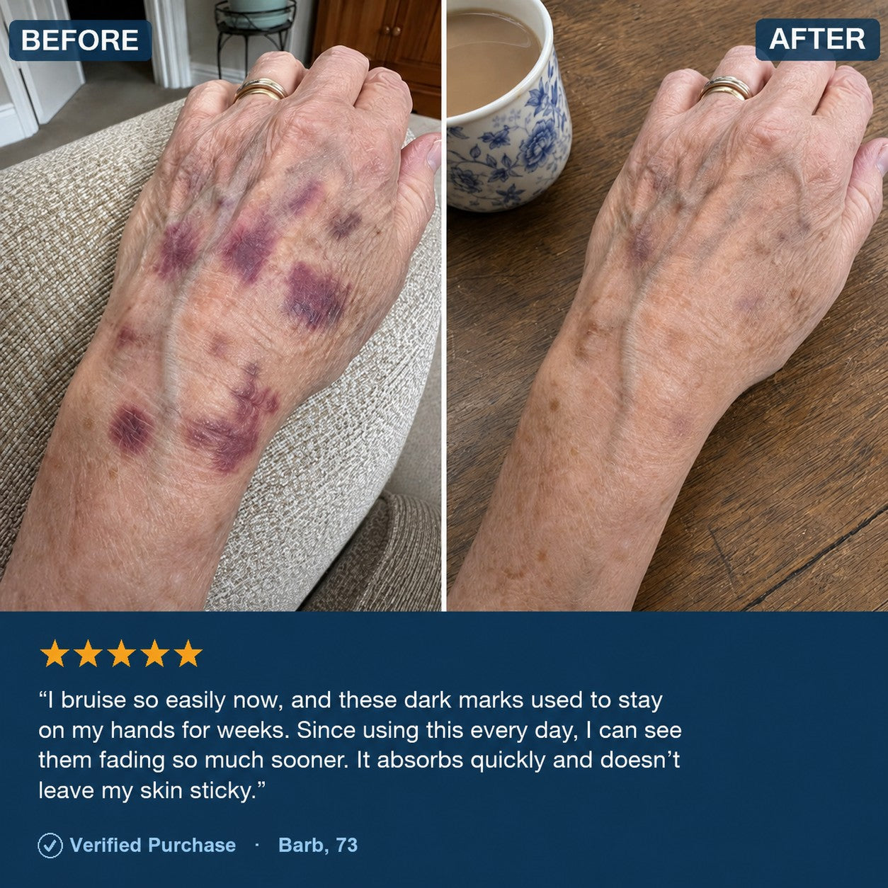 Before and after — bruises on the back of the hand fading