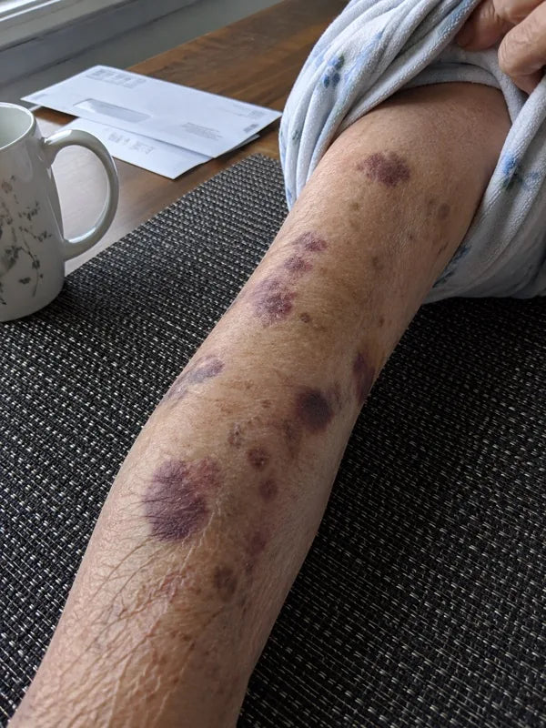 Before — forearm with several flat purple marks at different ages