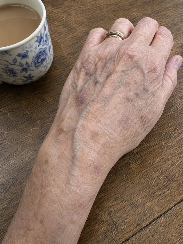 After — same hand and wrist, day 60