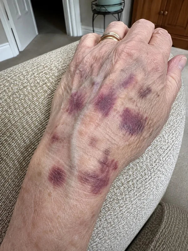 Before — back of the hand and wrist, day 1