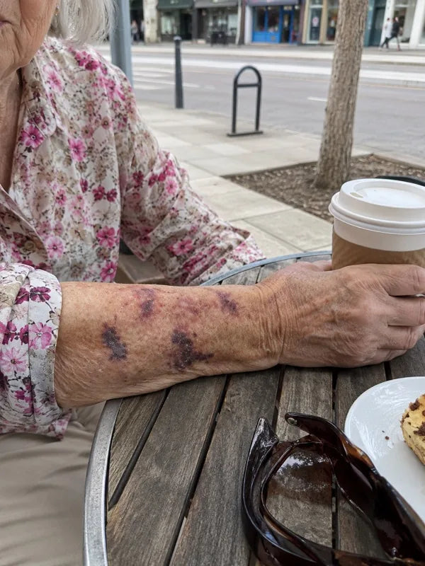 Before — forearm with marks at different ages on papery skin, day 1