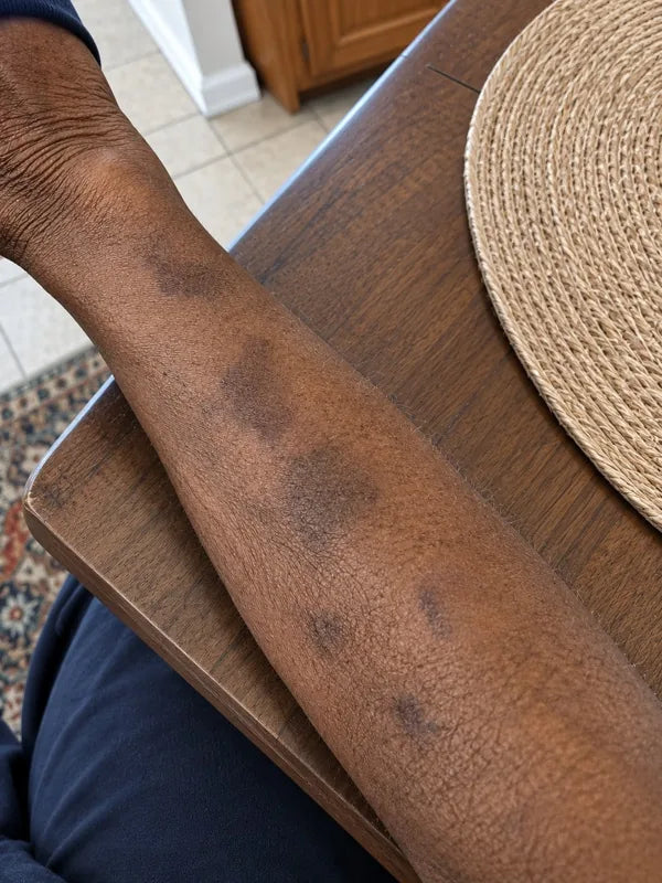 After — same inner arm, day 60