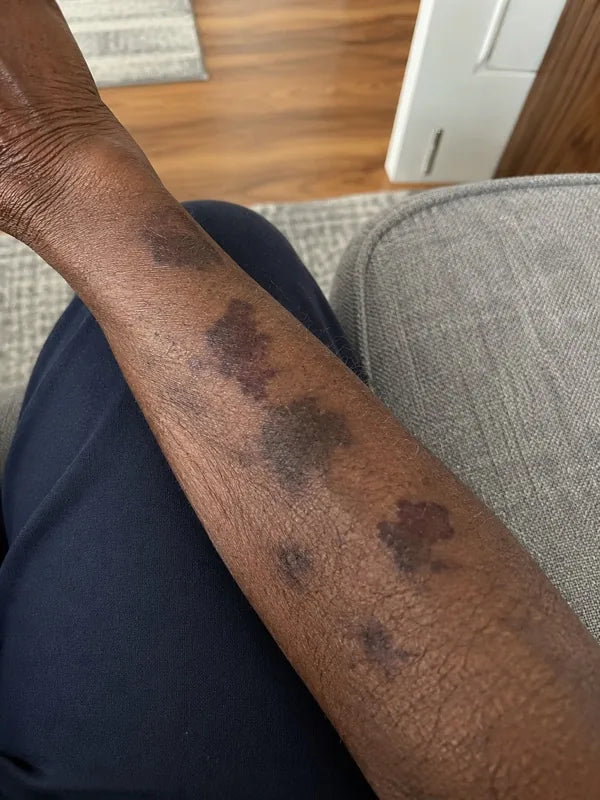Before — inner arm with several purple marks, one fresh