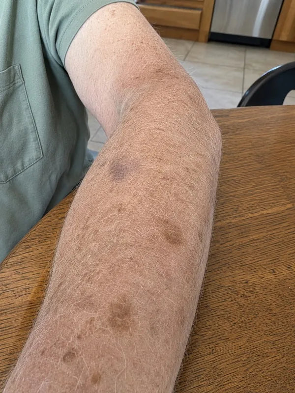 After — the same forearm, day 60, fewer marks