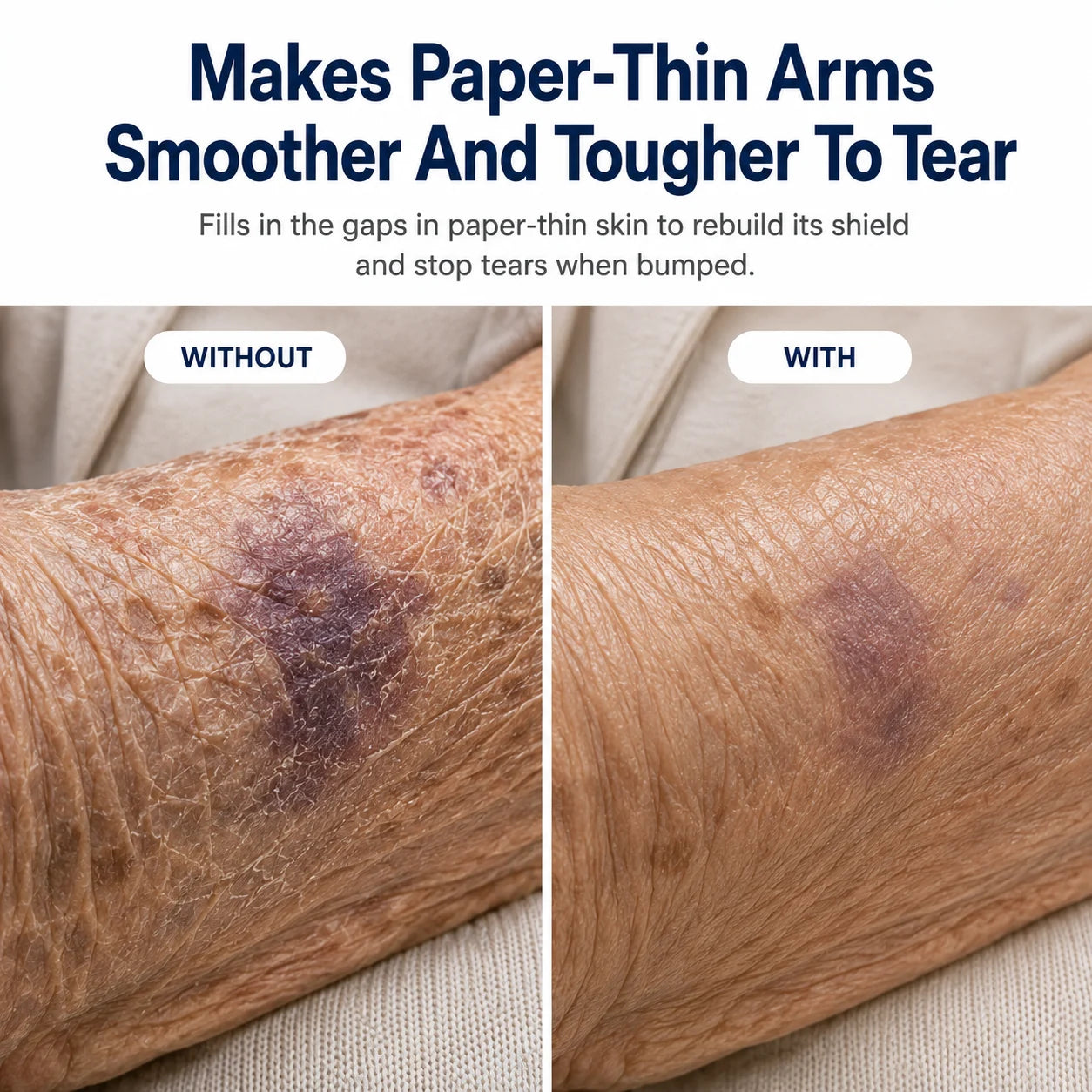 Five ceramides plus cholesterol and fatty acid rebuild the protective surface papery skin has lost