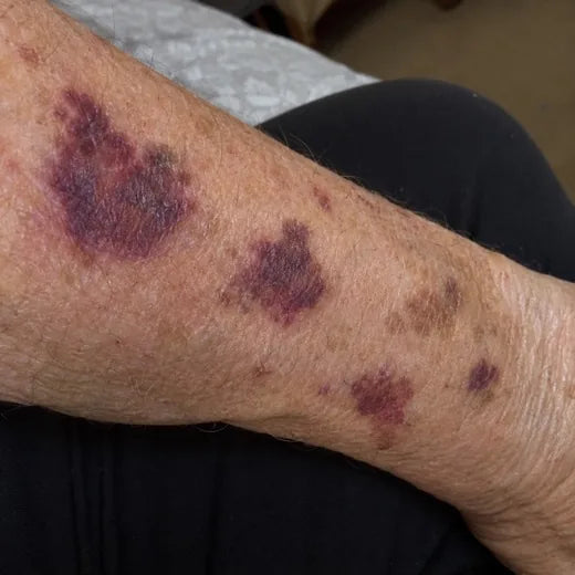 A forearm with several marks at different ages