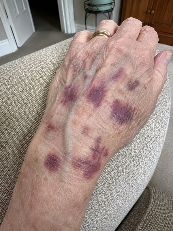 Before — back of the hand and wrist, day 1