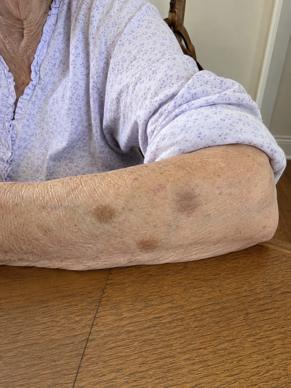 After — same forearm, day 60