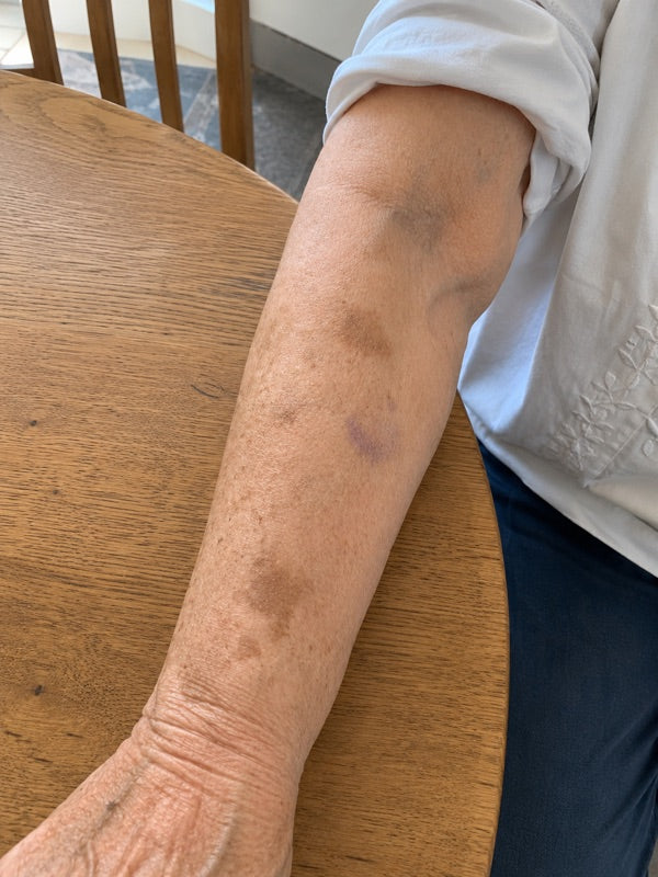 After — both forearms, sleeves pushed up, day 60