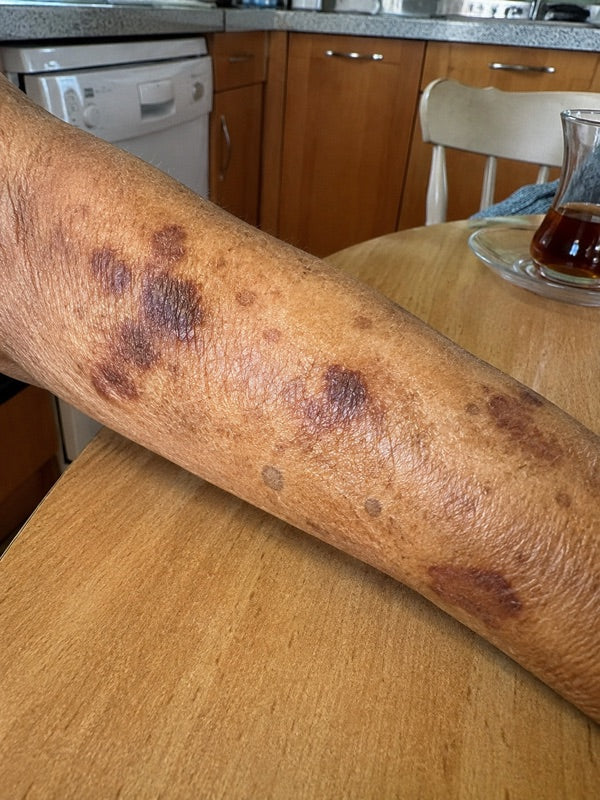 Before — forearm with several bruises, day 1