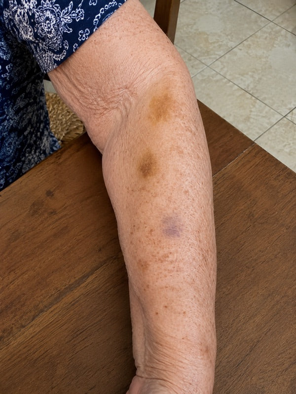 After — the same hand and wrist, day 60, fewer bruises