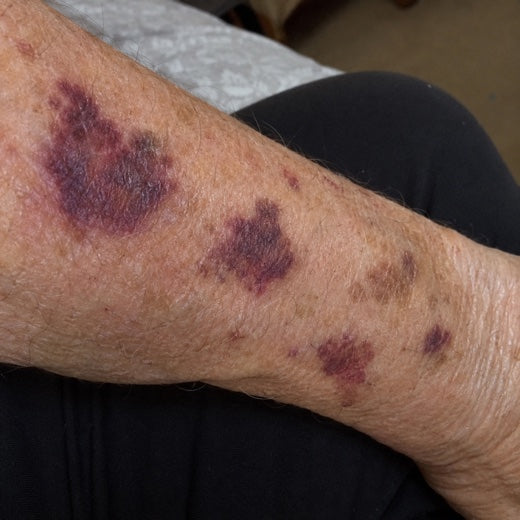 A forearm with several bruises at different stages