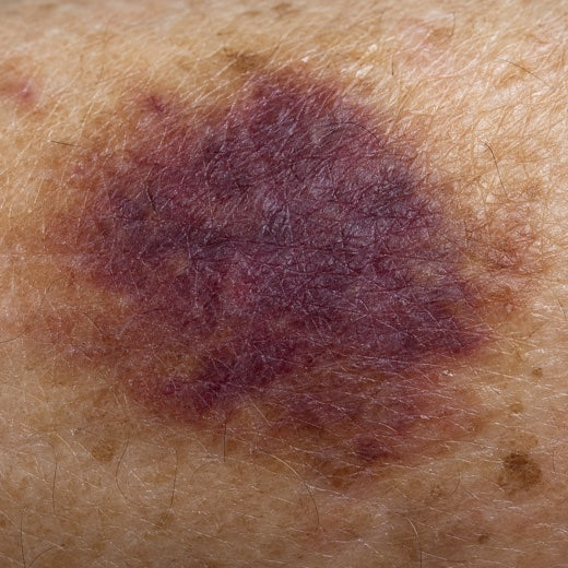 Close crop of a fading bruise